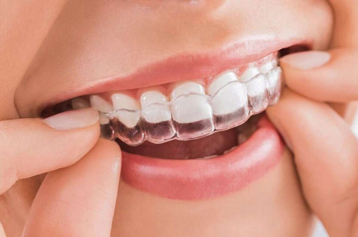 Niềng răng khay trong suốt có nhiều ưu điểm vượt trội giúp hành trình niềng của bạn dễ dàng hơn
