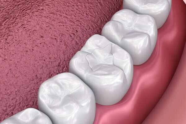 Trám răng bằng Composite có sắc trắng tương đồng răng thật